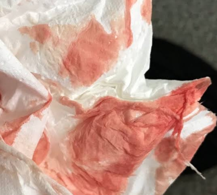 heavy implantation bleeding stories and pictures